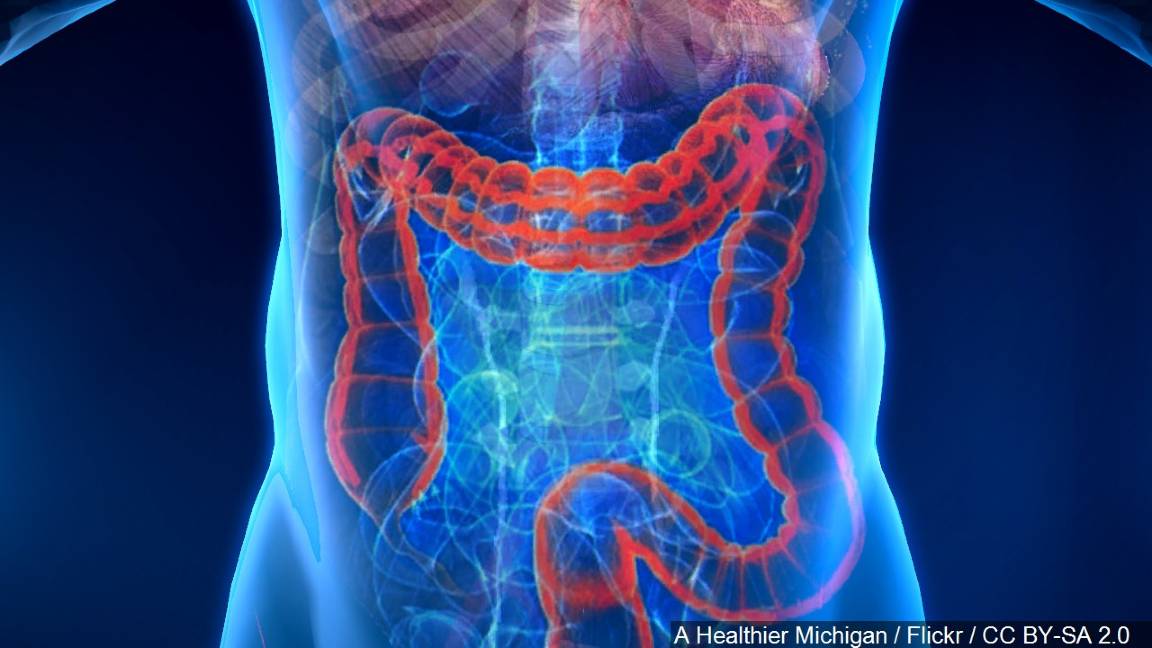 Colon Cancer Screening Should Start Earlier, at Age 45, panel ...